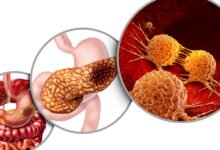 Revolution Medicines تحصل على موافقة أميركية لعلاج سرطان البنكرياس