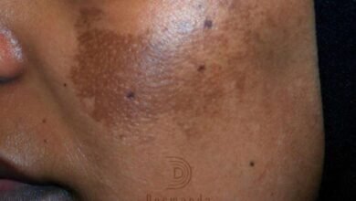Dermanda Clinic إسم رائد في علاج الكلف بمختلف أنواعه