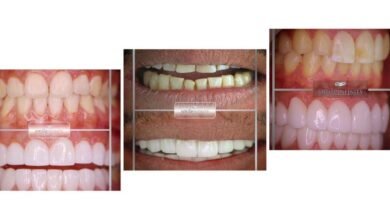 الدكتور Habib Zarifeh يقدم نصائح حول اختيار درجة اللون الأبيض Bleach المناسب لأسنان المريض